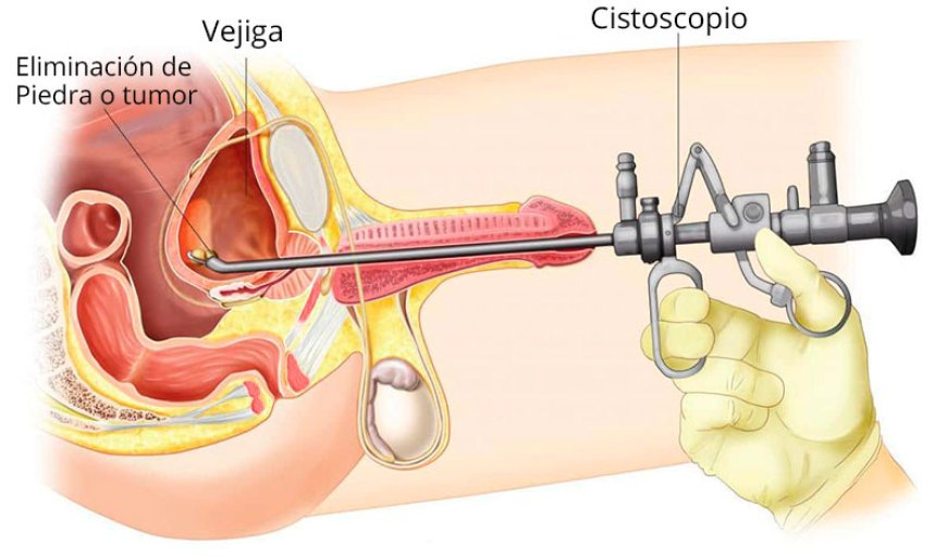 La cistoscopia: estudio esencial para detectar temprano el cáncer de vejiga