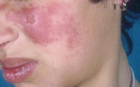 Lupus: ¿Qué es y por qué lo desarrollan las personas?