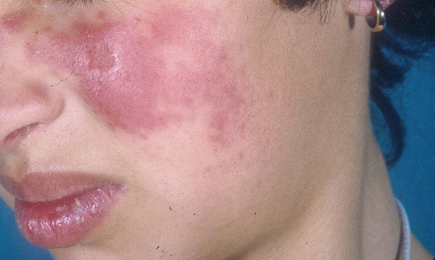 Lupus: ¿Qué es y por qué lo desarrollan las personas?