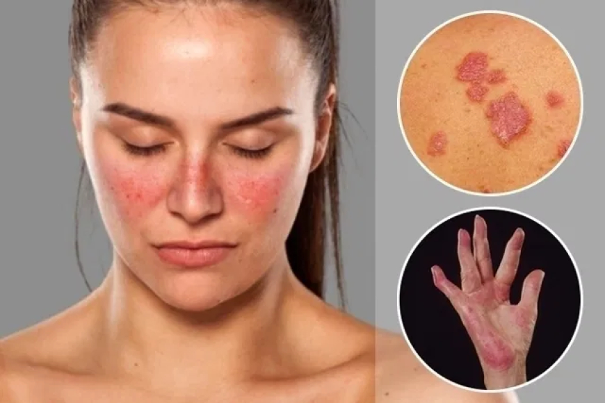Lupus: ¿Qué es y por qué lo desarrollan las personas?