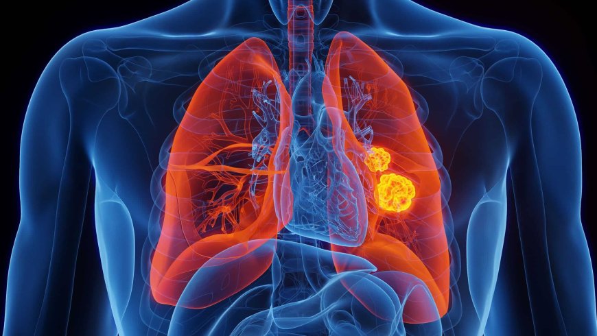 SAV: cáncer de mama, pulmón y cuello uterino: los que más impactan a las venezolanas