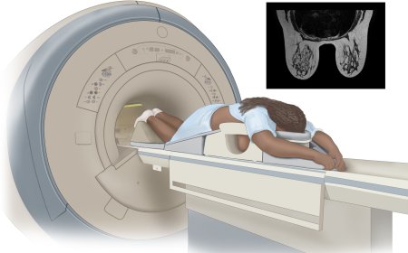 El diagnóstico temprano de cáncer de mama modifica el pronóstico de la enfermedad