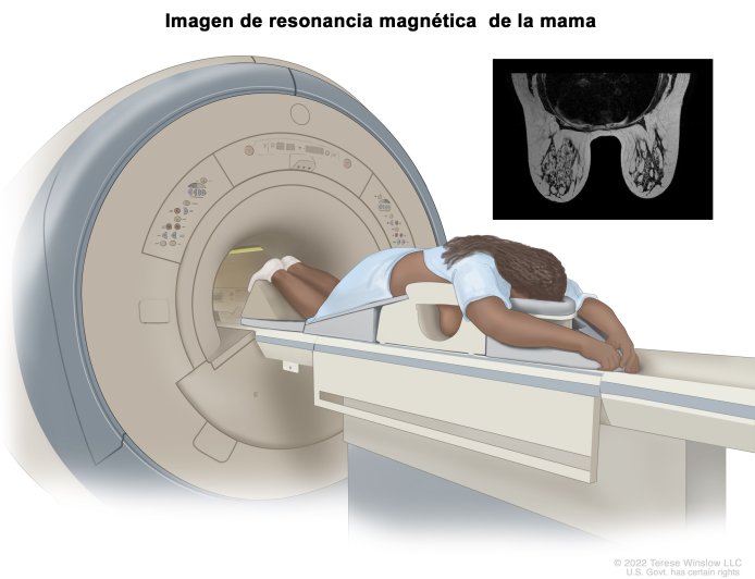 El diagnóstico temprano de cáncer de mama modifica el pronóstico de la enfermedad