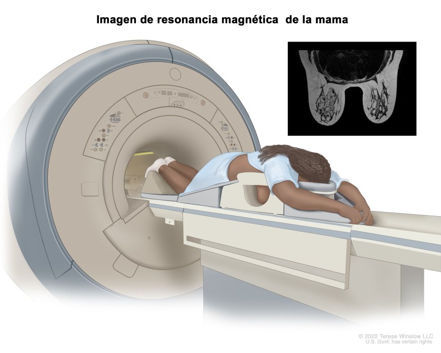 El diagnóstico temprano de cáncer de mama modifica el pronóstico de la enfermedad