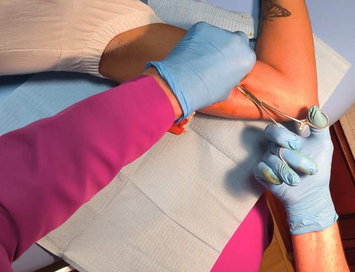 Implante subdérmico anticonceptivo para fortalecer la planificación juvenil