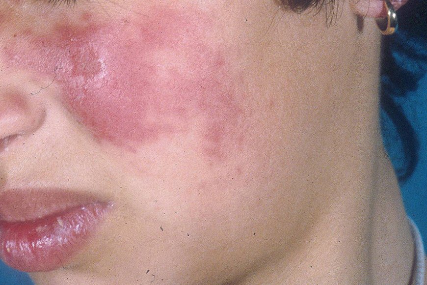 Lupus: ¿Qué es y por qué lo desarrollan las personas?