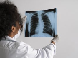 Cáncer de pulmón en Venezuela ocupa el segundo lugar en Venezuela