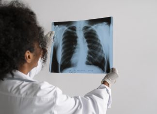 Cáncer de pulmón en Venezuela ocupa el segundo lugar en Venezuela