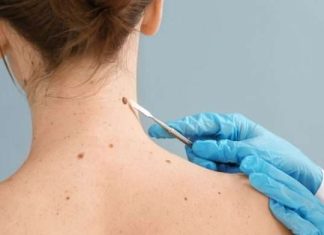 Aumentan en el mundo casos de cáncer de piel en los jóvenes