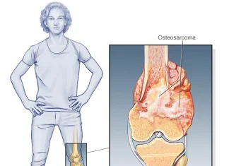 Dolor e inflamación persistentes en los huesos pueden alertar sobre tumores óseos